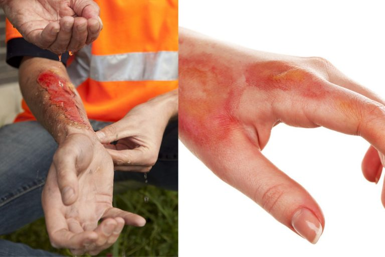 wound injury workers' compensation claim